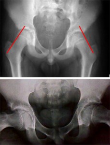 sufe Antero-posterior (AP) and frog lateral of SUFE.