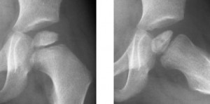 AP (left) and frog lateral (right) of Perthes condition